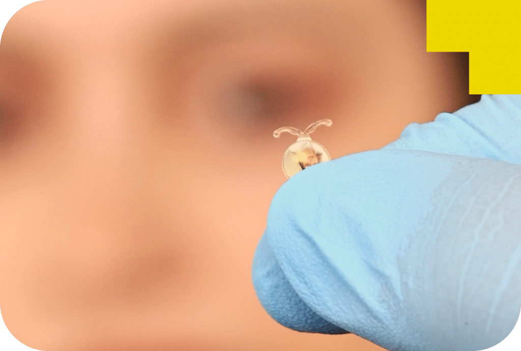 Ophtalmologue montrant un implant pour la correction de la vue